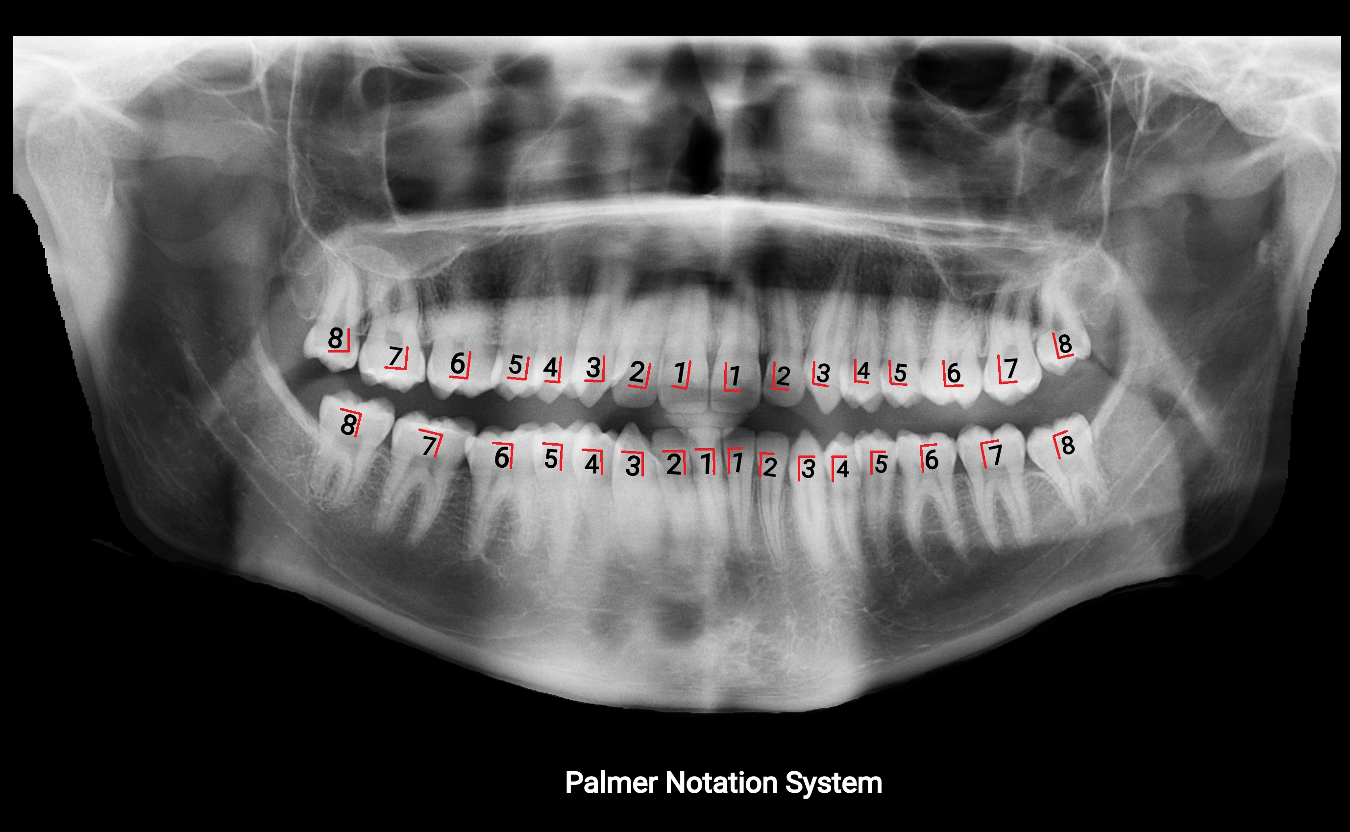 Orthopantomogram (OPG) X Ray anatomy labelled image 4.webp